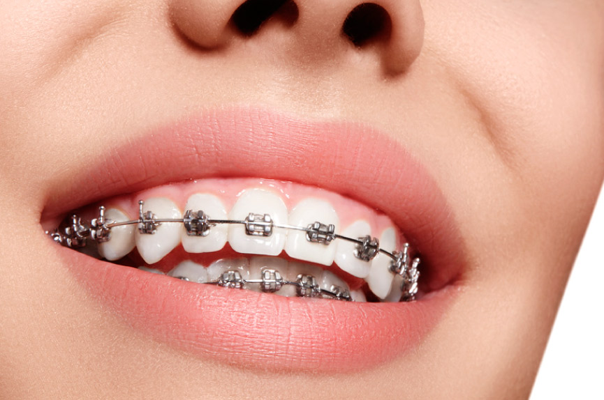 Brackets metálicos, tratamiento de ortodoncia en Elche