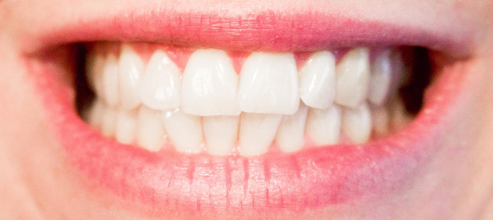 Maloclusión, un problema que se puede tratar a tiempo - Dental Roca