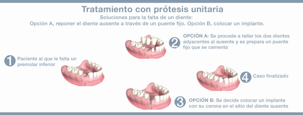 Prótesis, la solución práctica a la pérdida de piezas dentales - Dental Roca