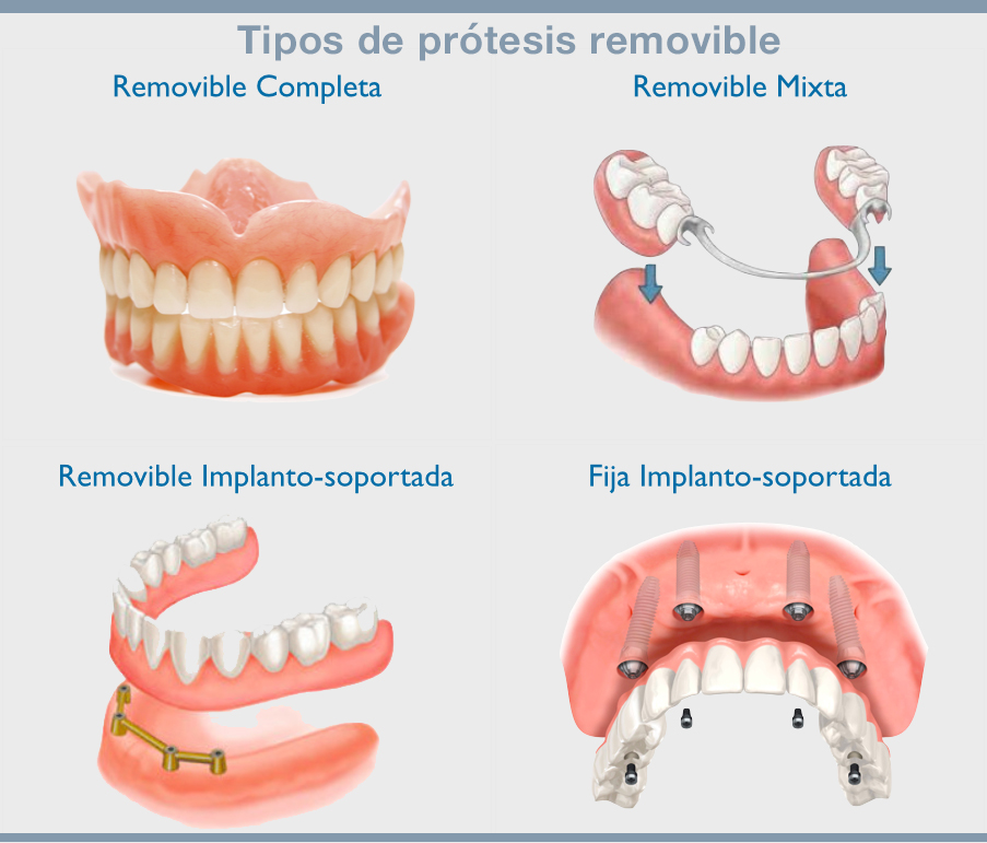 Prótesis, la solución práctica a la pérdida de piezas dentales - Dental Roca