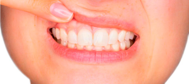 El sangrado de encías es una causa de enfermedad periodontal
