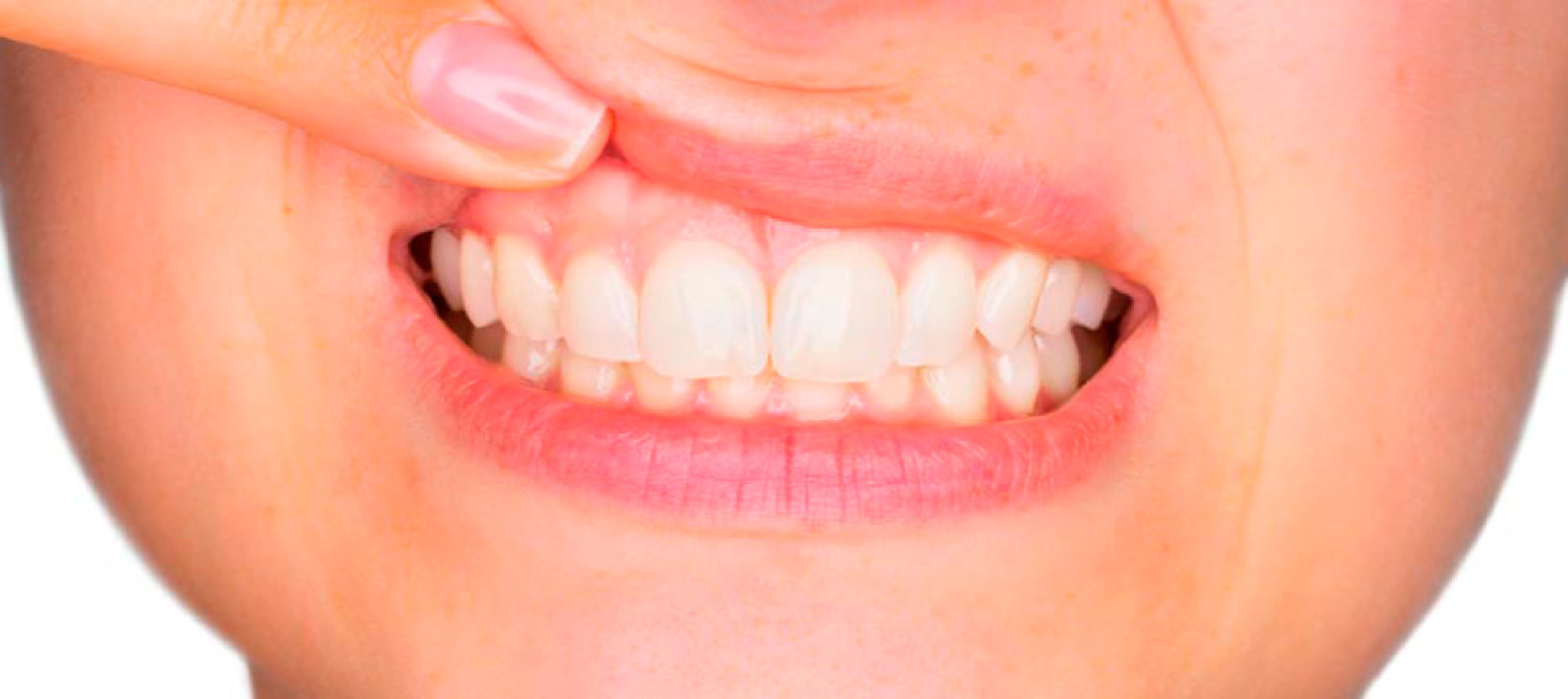 Evita que te sangren las encías y posibles enfermedades periodontales