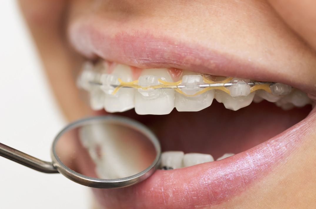 Brackets cerámicos como tratamiento de ortodoncia para corregir la mal posición de los dientes