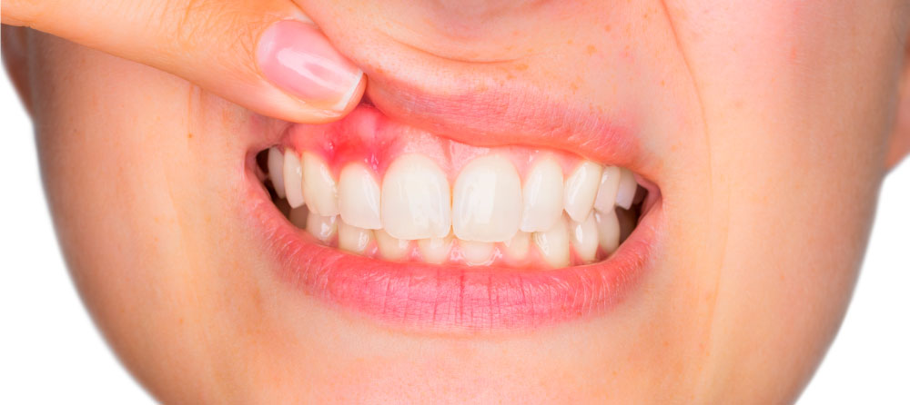Acude a Dental Roca en Elche con los mejores especialistas para curar las encías inflamadas