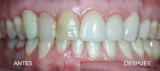 Caso de éxito de implante con corona dental