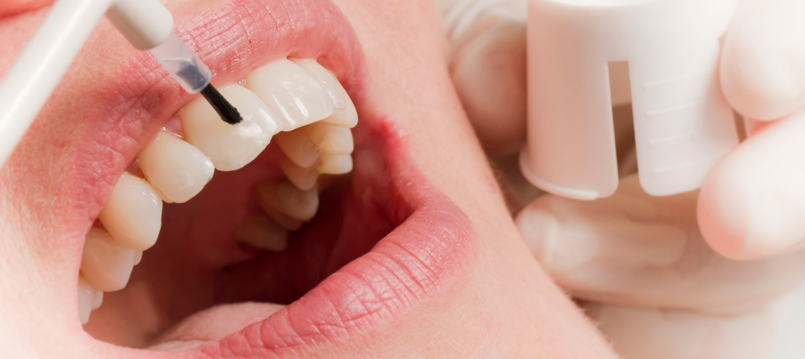 Blanqueamiento dental en Dental Roca