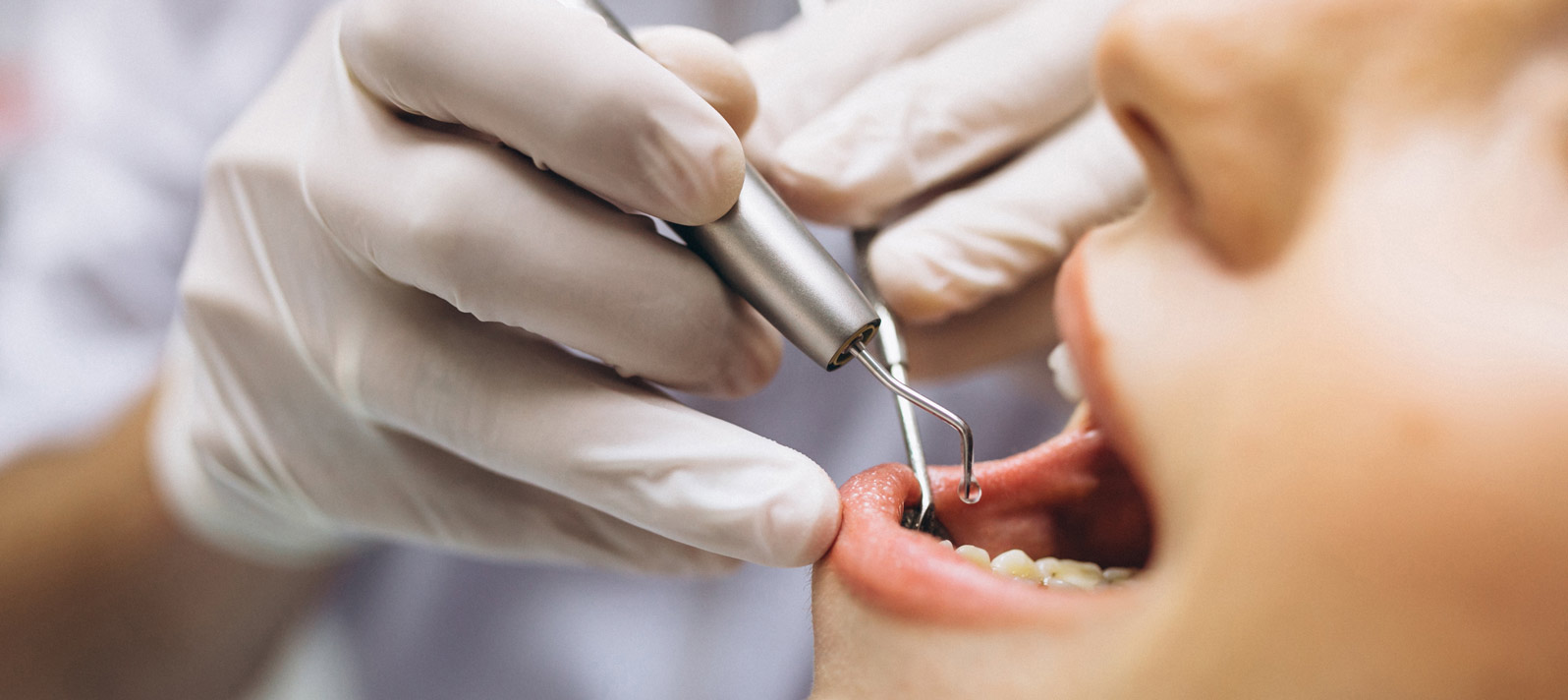 En Dental Roca realizamos cirugías para implantes dentales