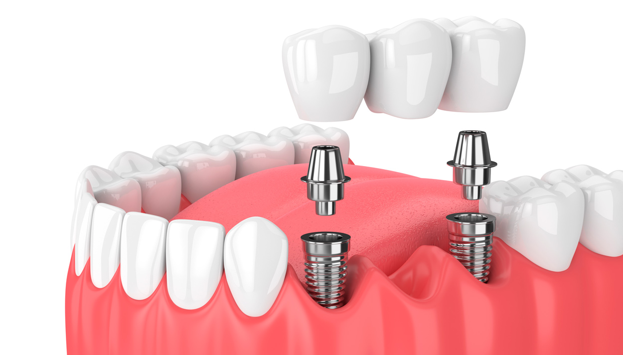 Vista previa de como quedarían los implantes dentales en una dentadura