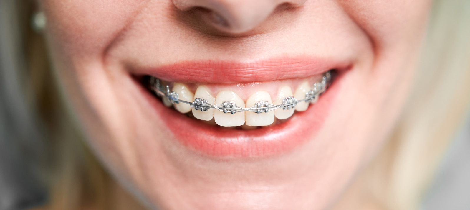 Llevas brackets? ¡Mejora tu higiene oral!