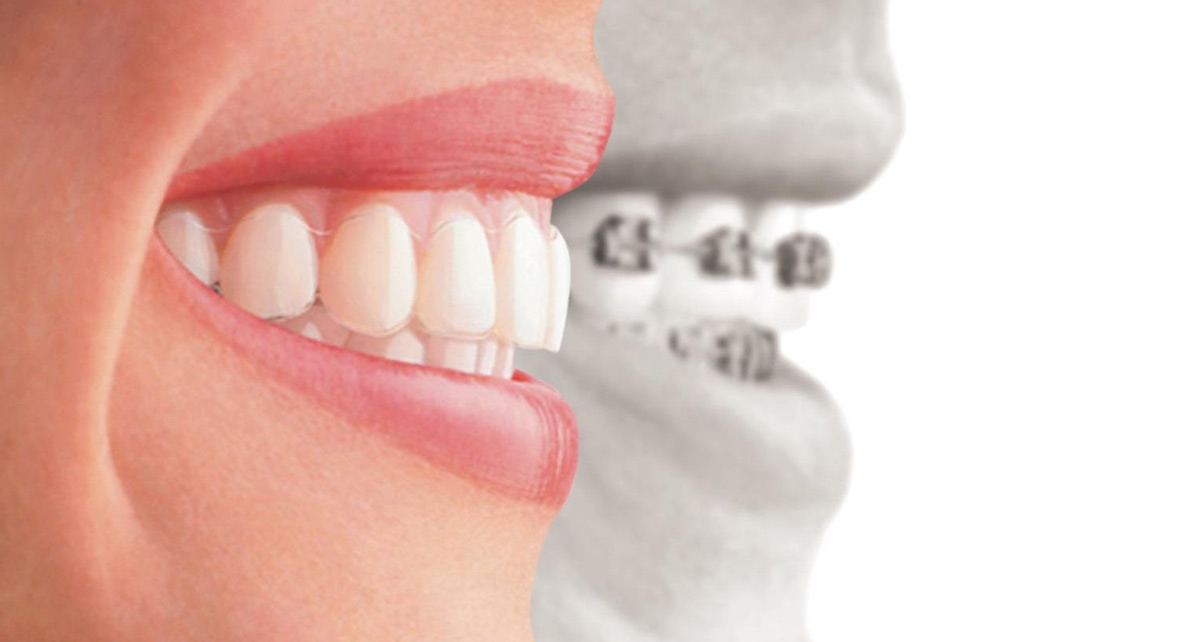 Incorrecta alineación dental, una de las enfermedades dentales más comunes