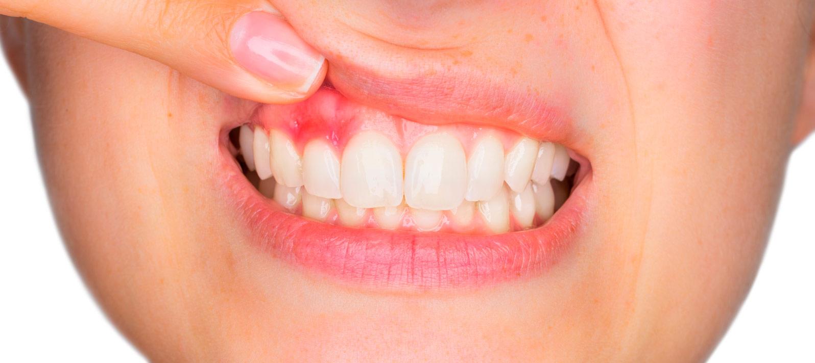 Tratamientos y soluciones a la periodontitis