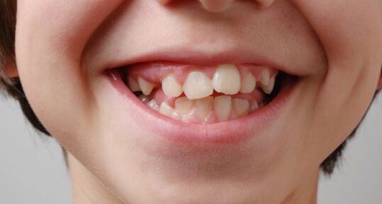 Dientes torcidos: causas, tratamientos y prevención