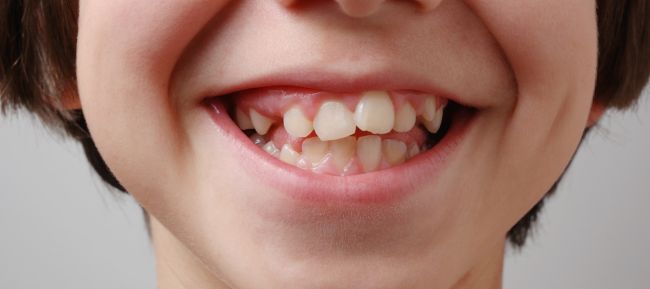 Dientes torcidos: causas, tratamientos y prevención