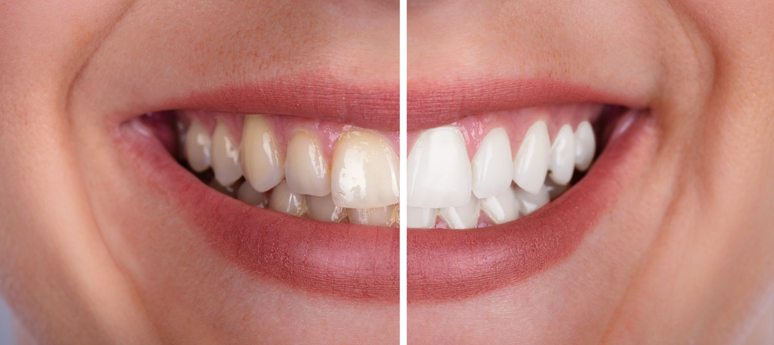 Cambio de color de dientes tras un blanqueamiento dental